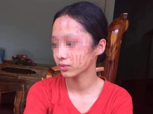 Nữ sinh lớp 8 bị cào cấu xước mặt
