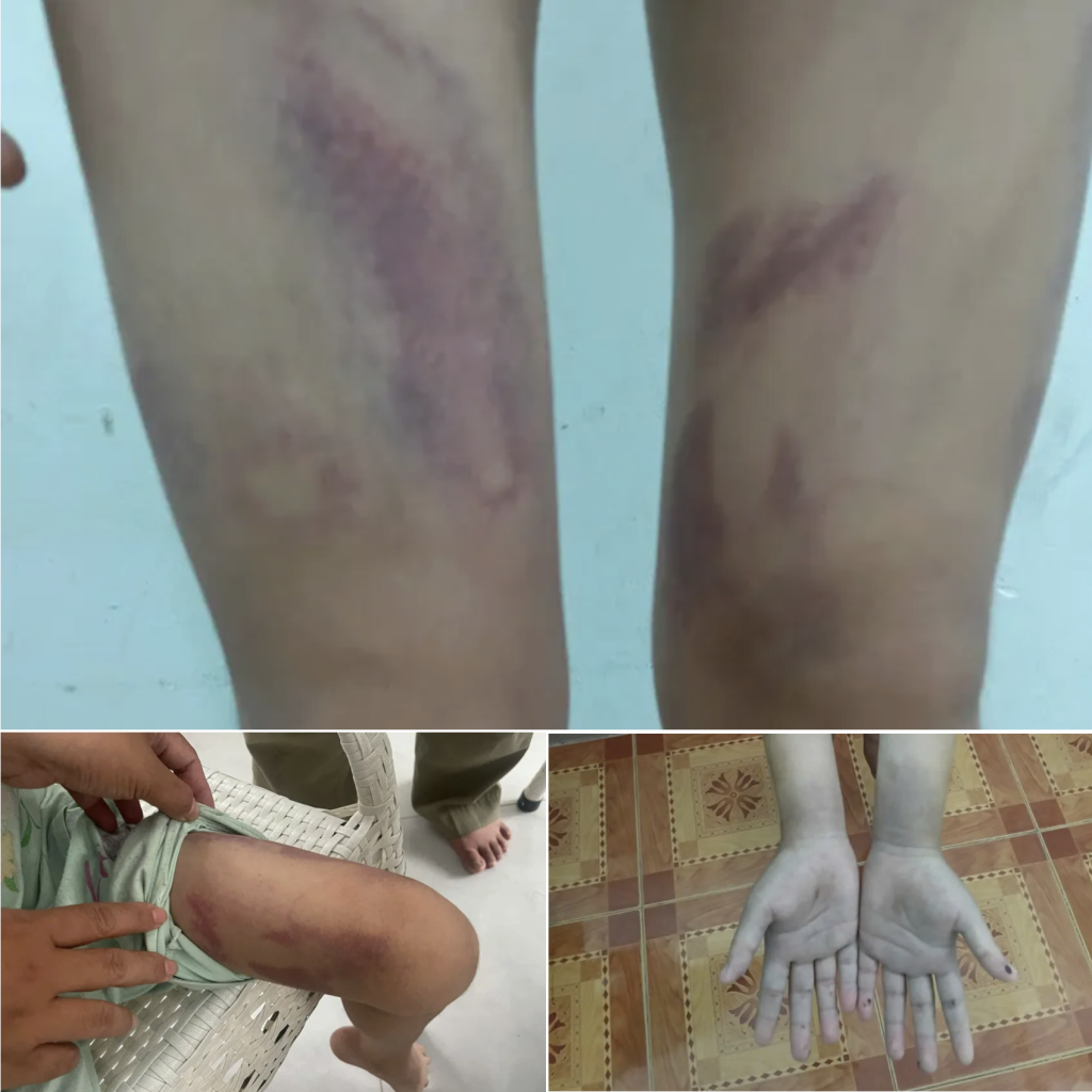Vụ bé gái 9 tuổi bị ép nhúng lưỡi vào nước sôi: Đang giám định thương tích 1 Vụ bé gái 9 tuổi bị ép nhúng lưỡi vào nước sôi: Đang giám định thương tích